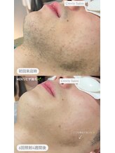 クレヴィー(Creviy)/ヒゲ脱毛経過