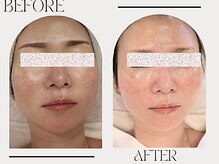ニコリ(NICOLI)/症例/しみケア/肌管理コース♪