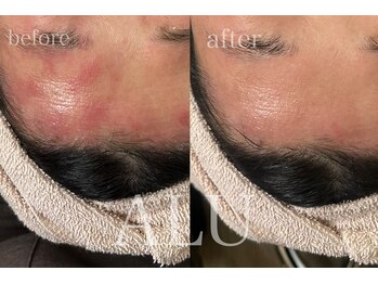 アルフォービューティー 難波店(ALU for beauty)/LDM症例