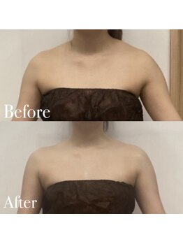 ボディヒーリングアンド小顔美容矯正 プララン/肩周りを華奢に☆