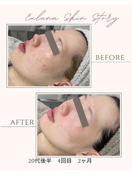 ユルナ(Euluna)/毛穴が気になる方