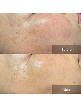 アウラ(Aula)/乾燥にも剥けないピーリング