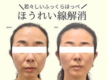 REGISTA ボディ&フェイシャルケアサロン/筋膜リリース/小顔矯正/実例！小顔矯正