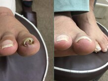 【巻き爪/深爪/フットケア】巻き爪本舗　津田沼店/この爪でも大丈夫