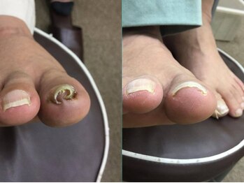 【巻き爪/深爪/フットケア】巻き爪本舗　津田沼店/この爪でも大丈夫