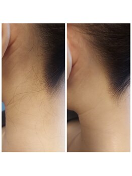 キアラ 麻布十番(Kiara)/うなじ脱毛麻布十番/毛穴/顔脱毛