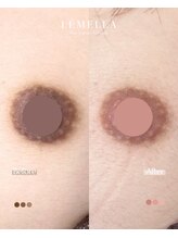 エルビービュティーサロン(LB BEAUTY SALON)/【ルメラ乳輪】実績数関西1★