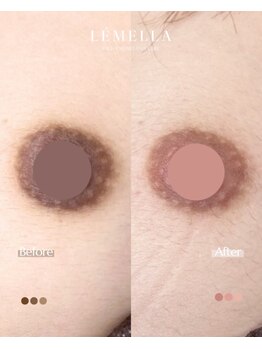 エルビービュティーサロン(LB BEAUTY SALON)/【ルメラ乳輪】実績数関西1★