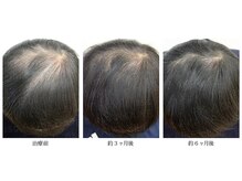 メンズ asc(men's asc)/ヘッドスパ3