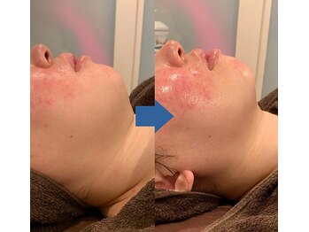 ピュアトゥルー 岐阜西店(PureTrue)/フェイスラインも綺麗に！