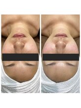 ランプ(LAMP)/～BBL光フェイシャル～