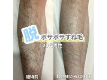 サロン(SALON)/メンズ脱毛：脚