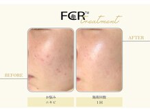 シャルム ココ 八尾店(Charme coco)の雰囲気（高濃度ハーブピーリング【FCRトリートメント】が八尾で出来る！）