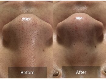 マヴィ(Mavie)/韓国式3D毛穴洗浄