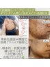 【剥離なしハーブピーリング+ヒト幹細胞導入】小顔矯正スクラブピーリング付