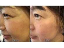 はやしだ鍼灸整骨院/美容鍼→顔のむくみ◎