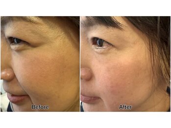 はやしだ鍼灸整骨院/美容鍼→顔のむくみ◎