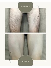 メロウ(mellow)/メンズ太もも6回施術☆