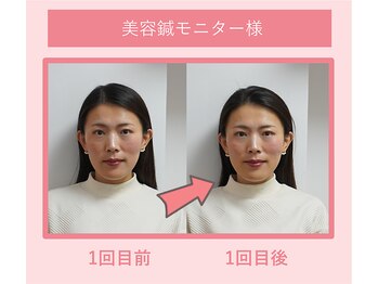 グリーンノア鍼灸院/40代美容鍼を1回受けた変化