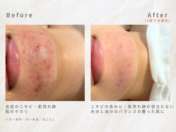 メレ(mele)/20代ニキビケア/毛穴