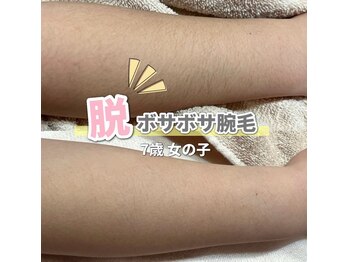 サロン(SALON)/キッズ脱毛：腕