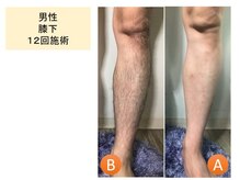 ラグゼ(LUXE)/まるっと脚脱毛！