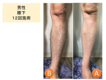 ラグゼ(LUXE)/まるっと脚脱毛!