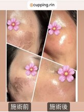 カッピングアンドカッサ専門店 凜(Rin)/剥けピーリング1回での変化