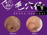 人気No.1美肌レシピ×松ヤニパック×毛穴侍２回コース¥13400→¥12200