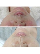 ルアナ 柏店(LUANA)/ララピール【before・after】