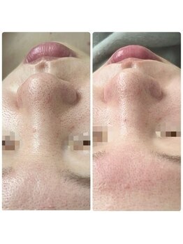 ファーファラ(Farfalla)/毛穴洗浄×水光ピール