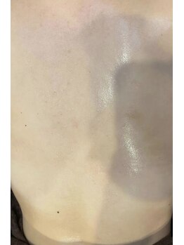 トゥモロー(TOMORROW)/ハーブピーリング/肌質改善