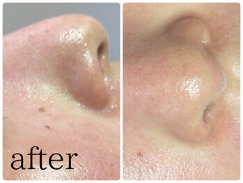 ユルリラ イロ(yururira iro)/毛穴洗浄フェイシャル*after