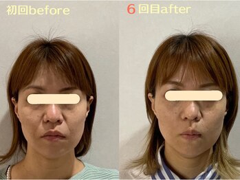 エスポワール(espoir)/初回before・６回目after