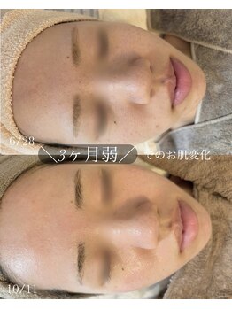 ソア/【毛穴改善　豊橋肌質改善】