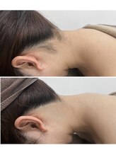 ミース 福岡本店/うなじ矯正◆ビフォーアフター