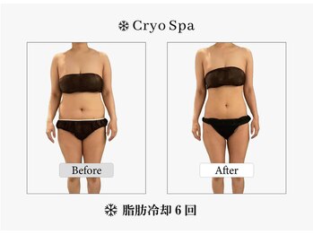 クリオスパ 豊春店(Cryo Spa)/脂肪冷却Before/After