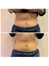 ビュウナ 銀座(BEAUNA)/脂肪冷却/frozen8