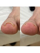 スマートリフト 五反田 大崎店(SMART LIFT)/巻き爪改善施術【大崎/五反田】