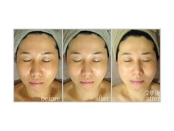 アン グレーヌ 自由が丘(unegraine)/血流アップすると透明感が出ます