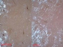 ナチュラ ソース(NatureSouce)/毛穴に特化したコースもご用意♪