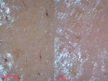 ナチュラ ソース(NatureSouce)/毛穴に特化したコースもご用意♪