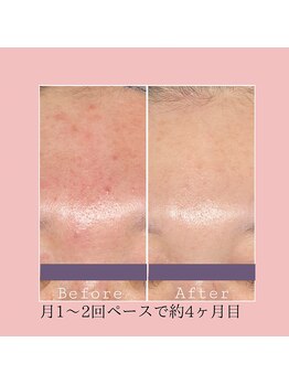 ラ ジェム(La gemme)/【プラズマシャワー】