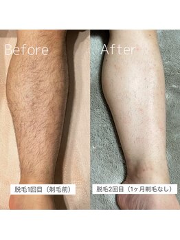 エフイーサンニーイチ(Fe-321)/足 メンズ脱毛