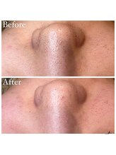 マドモアゼル 麻布十番/毛穴洗浄