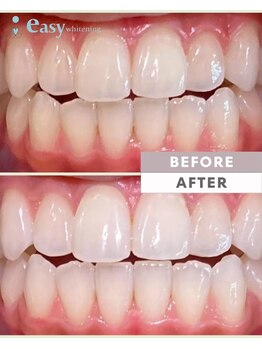 イージーホワイトニング 新宿店(easy whitening)/歯科医院提携サロン【代々木】