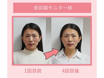 グリーンノア鍼灸院/40代女性美容鍼4回目の変化