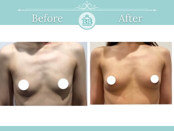 美人バスト 柏店/【バストアップ・育乳】症例