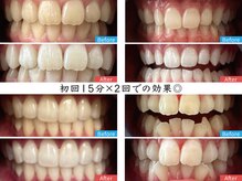 ホワイトニングのチェアはマッサージ付 / メンズにも◎