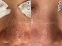 ウル 下北沢(Ulu)/毛穴洗浄×ハーブピーリング